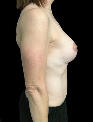 breast lift augmentation and abdominoplasty body lift mummy makeover Dr Sharp 6 JL 2