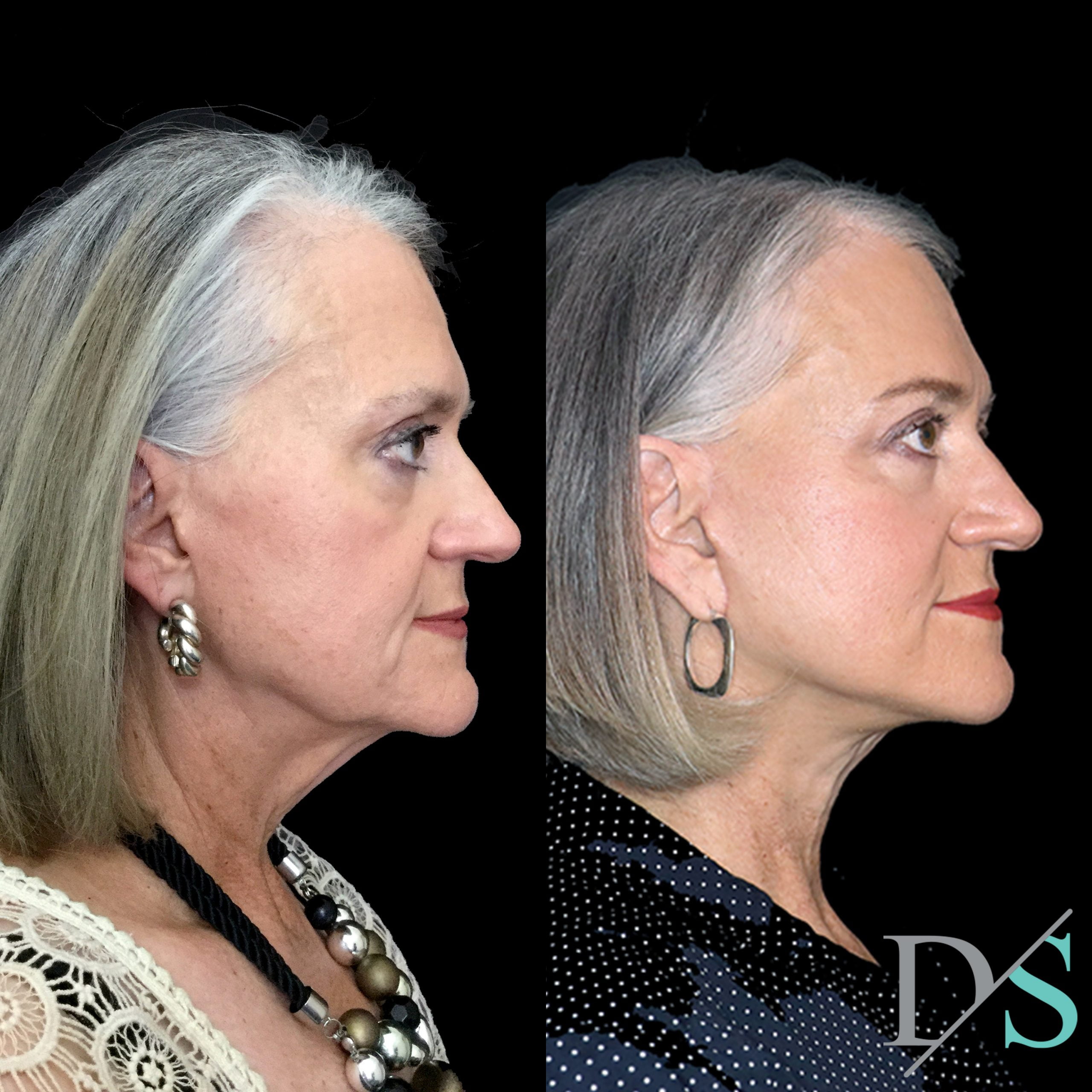 facelift before and after Dr Sharp scaled