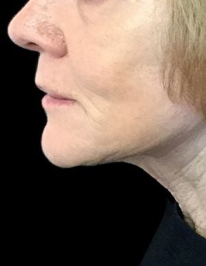 facelift with Dr Sharp RI 6