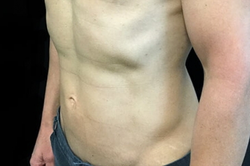 liposuction abdomen Brisbane after Dr Sharp ND 1