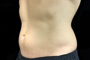 liposuction abdomen Brisbane before Dr Sharp ND 1
