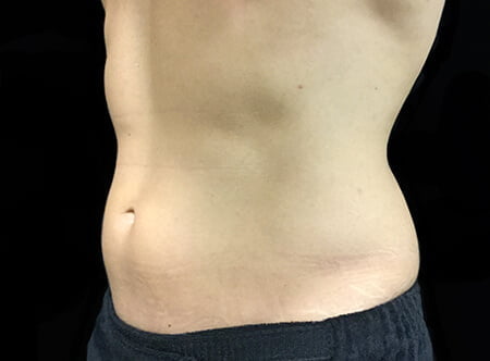 liposuction before surgery
