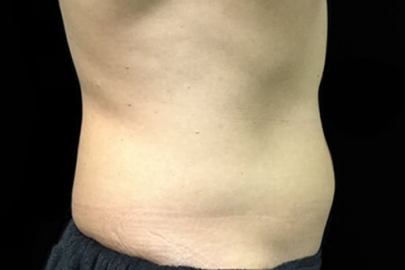 liposuction abdomen Brisbane before Dr Sharp side ND 1