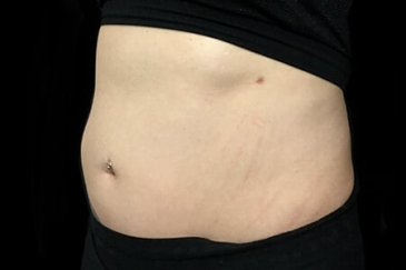 liposuction surgeon to stomach before RJ 1 1