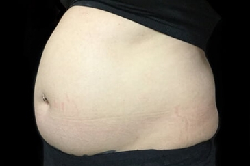 liposuction surgeon to stomach before RJ 1