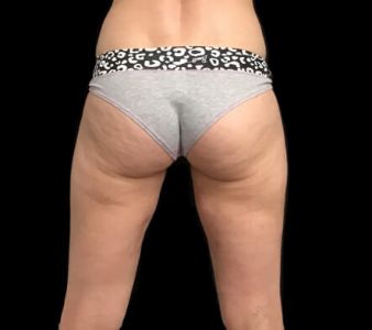 liposuction outer hips and flanks AB 1 1