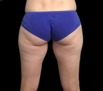 liposuction outer hips and flanks AB 2 1
