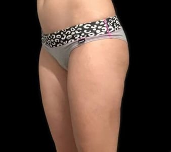 liposuction outer hips and flanks AB 4 1