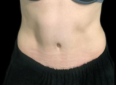 post pregnancy tummy tuck Dr Sharp VB