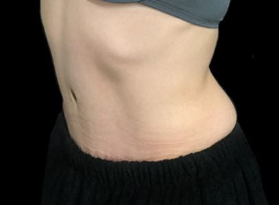 post pregnancy tummy tuck Dr Sharp VB 4