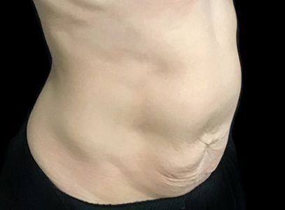 post pregnancy tummy tuck Dr Sharp VB 6