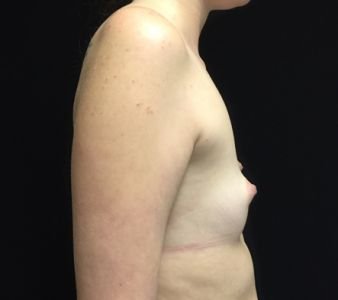 5. Brisbane breast augmentation clinic reviews