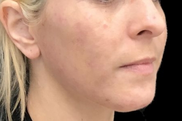 Acne after 1 peel and Synergie products