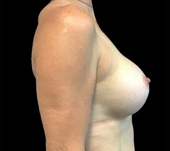 Breast augmentation Dr David Sharp plastic surgeon after ST side 4