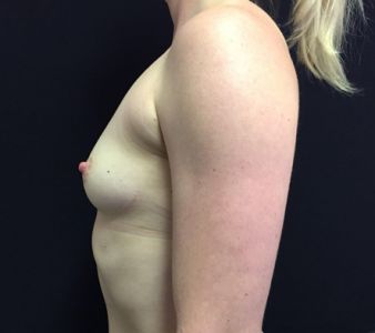 Breast augmentation surgeon Brisbane Ipswich reviews 1e