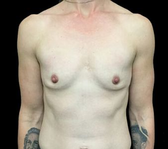 Breast augmentation 345cc anatomical high profile Mentor NK 1
