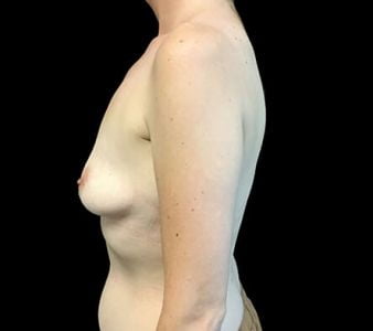 Breast augmentation 380 and 430 cc high profile anatomical BAM MS 3