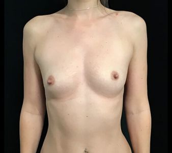 Large breast implants - 26