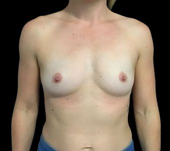 Breast augmentation surgeon Brisbane 330cc anatomical moderate plus profile implants ZM 1