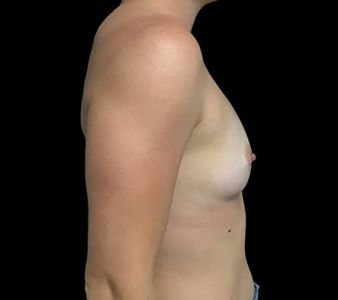 Breast augmentation surgeon Brisbane 330cc anatomical moderate plus profile implants ZM 3