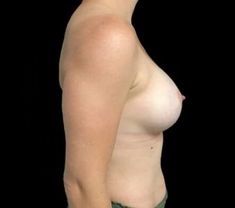 Breast augmentation surgeon Brisbane 330cc anatomical moderate plus profile implants ZM 4