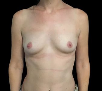 Breast augmentation surgeon Dr David Sharp Brisbane LF1 copy