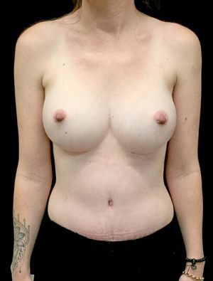 Brisbane abdominoplasty and breast augmentation mummy makeover clinic SK 2