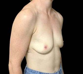 Brisbane breast augmenation Dr Sharp 300cc anatomical high profile Mentor RP 5 copy