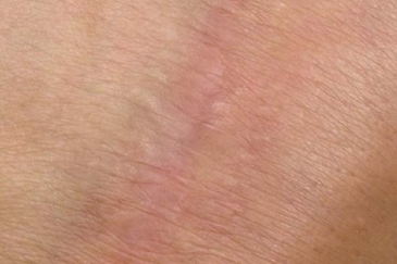 Dermapen after hand scar therapy1