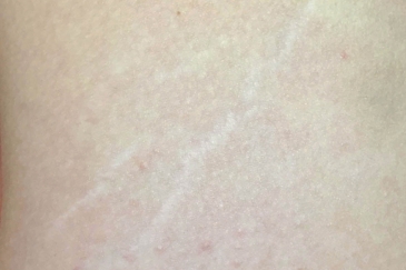 Dermapen micro skin needling before photo stretch marks