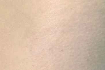 Dermapen micro skin stretch marks needling after photo