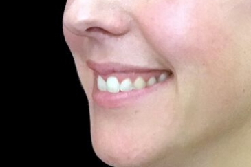 Gummy smile injections after The Sharp Clinic HT