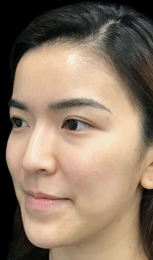 Hydrafacial clinic acne congestion after photo