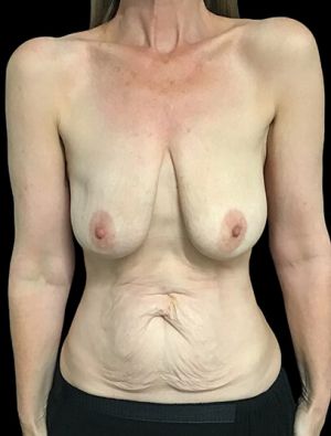 Postpartum abdominoplasty with abdominal wall reconstruction - 194