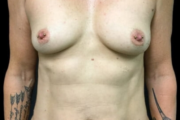 Mummy makeover breast and mini abdominoplasty before ST