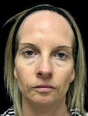 Facial and Revolumising Fillers - 33