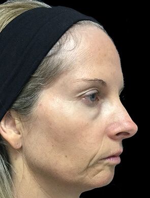 Facial and Revolumising Fillers - 35