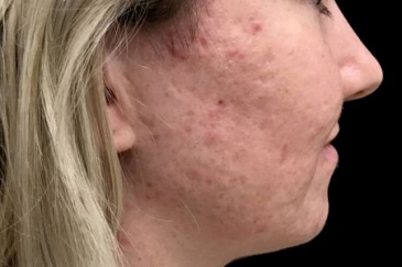 Skin peels acne anti ageing therapist Brisbane Ipswich JC 1