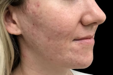 Skin peels acne anti ageing therapist Brisbane Ipswich JC 2