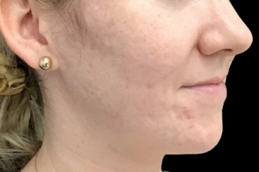 Skin peels acne anti ageing therapist Brisbane Ipswich JC 3