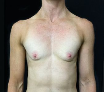 a. Breast augmentation for fit woman before photo 1