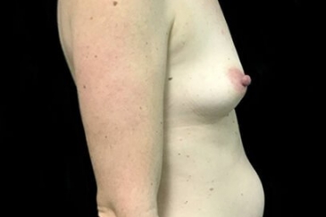 abdominoplasty and breast augmentation plastic surgeon Dr David Sharp Brisbane before