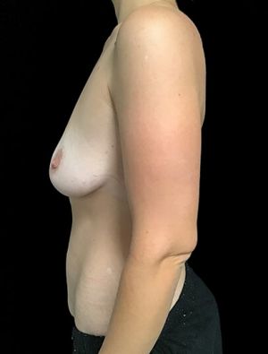 Mastopexy - breast lift - 79