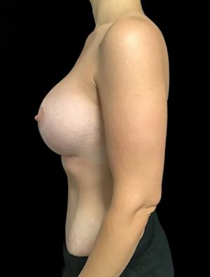 Mastopexy - breast lift - 82