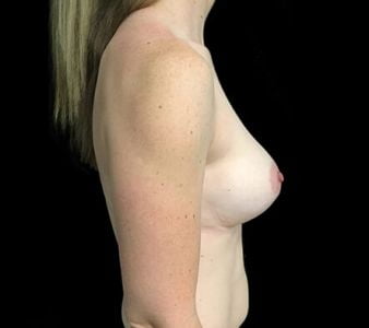before breast augmentation with Dr Sharp 345cc anatomical high profile implants AT 4 copy