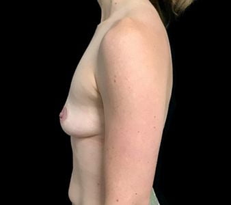 before breast augmentation with Dr Sharp 345cc anatomical high profile implants AT 5