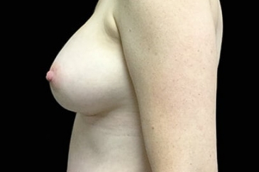 Postpartum abdominoplasty with abdominal wall reconstruction - 177