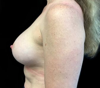 breast augmentation mature aged after ZR side