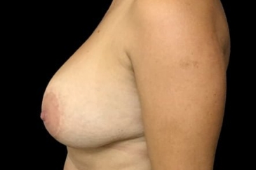 breast implant remove and replacement revision lift ZM before