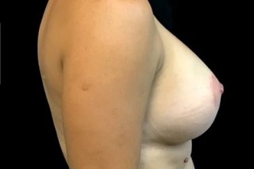 breast implant remove and replacement revision lift ZM side after